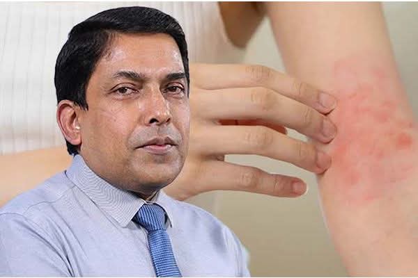 நாட்டில் வேகமாக பரவும் தோல் நோய்; சுகாதார அதிகாரிகள் - மக்களுக்கு எச்சரிக்கை.!!!
